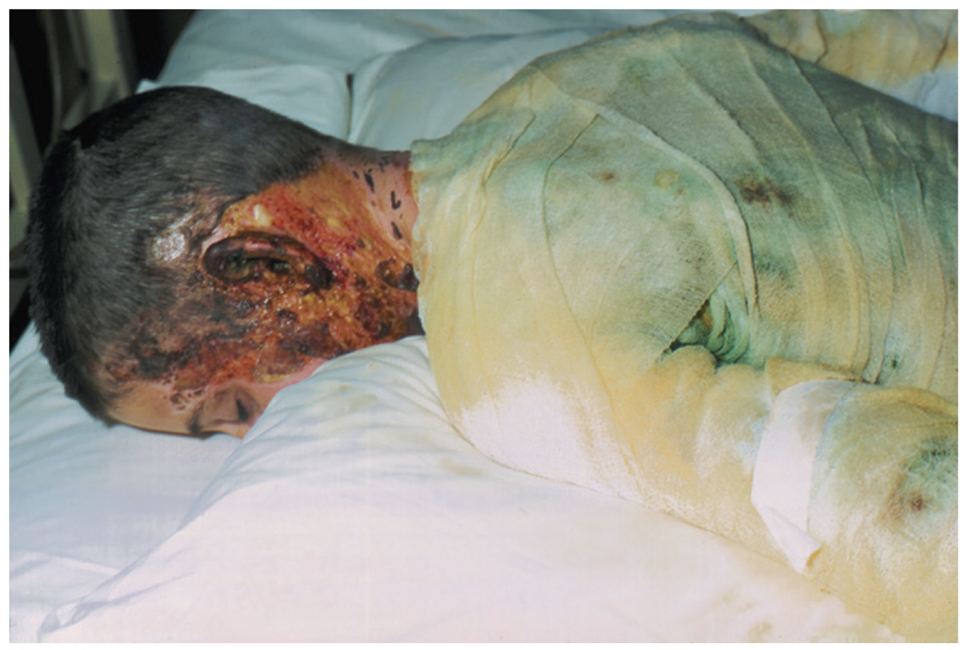 <p><span style="background-color: transparent;"><span>Blue-green pus due to pigment produced by bacteria; under nails </span></span></p><ul><li><p><span style="background-color: transparent;"><span>Opportunistic pathogen; burns or open skin</span></span></p></li></ul><p><span><span>Route of Transmission: water borne, direct contact, nosocomial infections</span></span></p><p><span><span>— self limiting (cleared by body) </span></span></p><p></p>