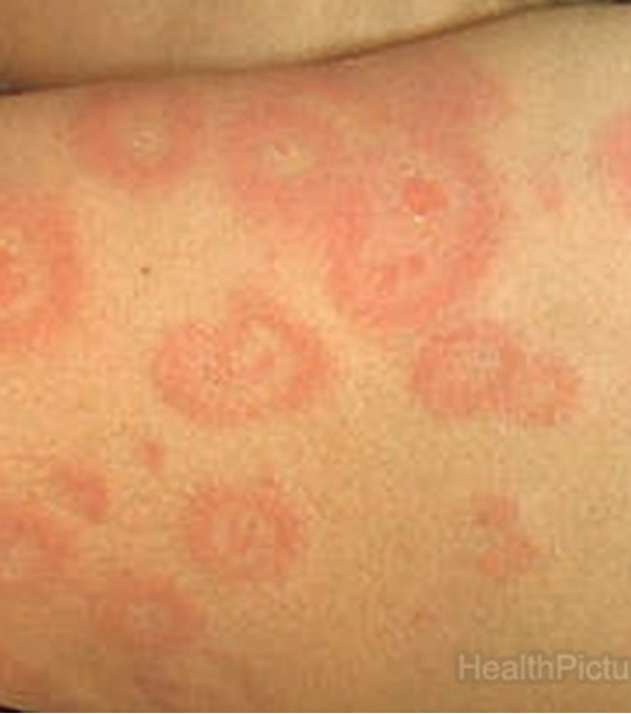 <p>acute cutaneous eruption to skin or mucous membranes that is benign and self limited</p><p>lesions develop in crops on <strong>acral surfaces (affects distal portions of limbs);</strong></p><p><strong>monomorphous pattern</strong>- red macule o thin papule that expands from center outward, center becomes dusky or necrotic appearing “<strong>target-like</strong>”</p>