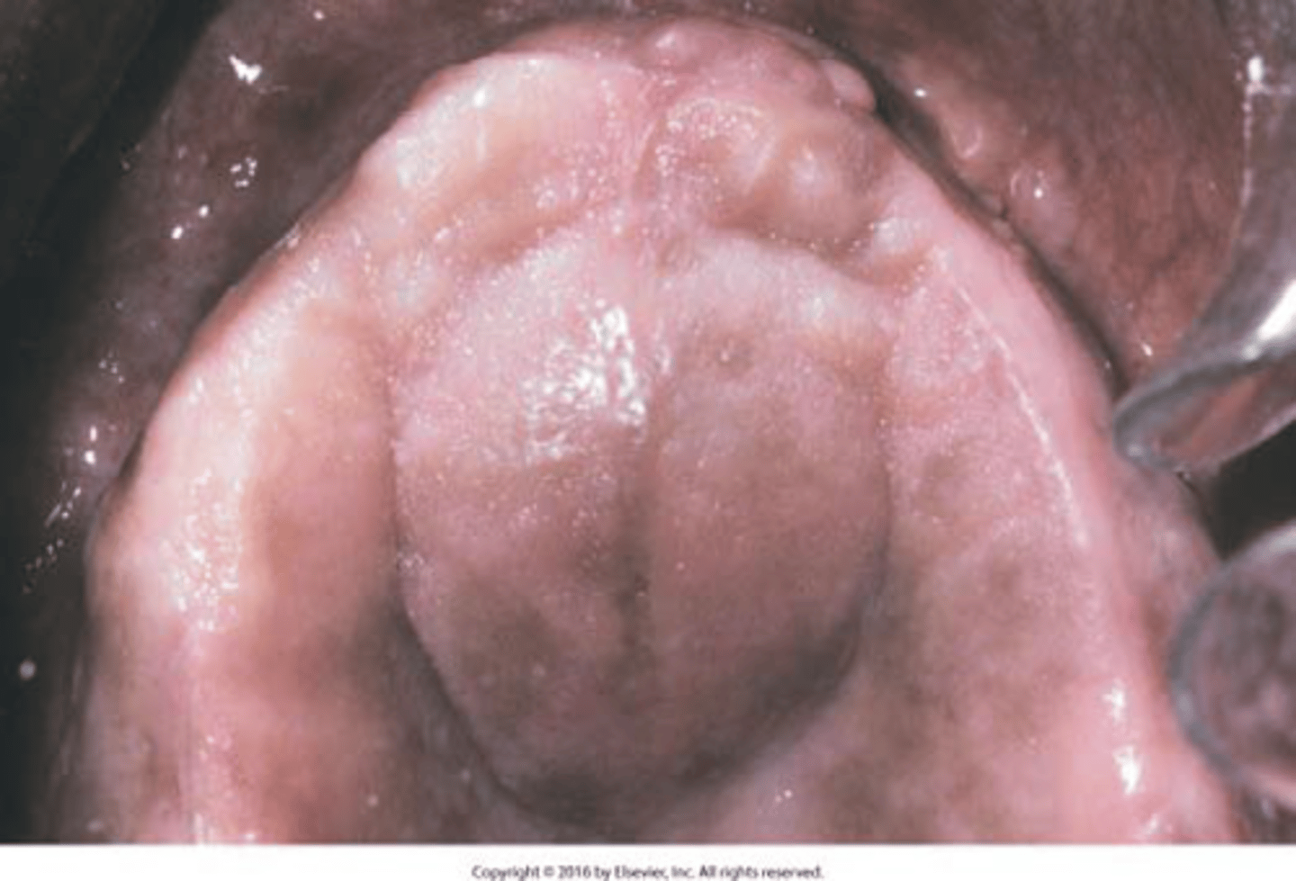 <p>• pink swelling of incisive papilla area</p><p>• teeth are VITAL</p><p>• asymptomatic</p>