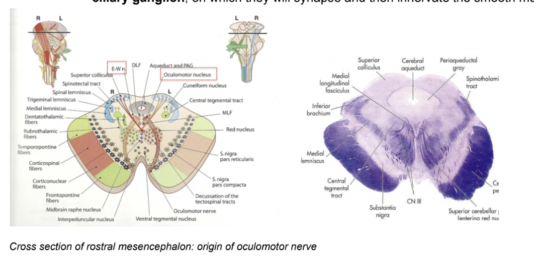 <ul><li><p>3rd cranial nerve — motor neuron — in the <u>mesencephalon</u></p></li><li><p>Emerges through the interpeduncular fossa of the brainstem — thus originating from the midbrain</p><ul><li><p>Motor nucleus located in the rostral part of the tegmentum of the midbrain</p></li></ul></li><li><p>Innervates <u>most</u> of the extraocular eye muscles</p><ul><li><p>These originate from paraxial mesoderm —thus nerve has a general somatic efferent component</p></li></ul></li><li><p>Also contains parasympathetic fibers to the intrinsic smooth muscles of the eye — thus also hase a gneral visceral efferent component</p><ul><li><p>This parasympathetic innervation originates from the <u>Edinger Westphal</u> nucleus — parasympathetic preganglionic nucleus in the tegmentum of the midbrain</p><ul><li><p>(The oculomotor nerve originates from 2 nuclei in the midbrain[1]: Oculomotor nucleus. Accessory parasympathetic nucleus (Edinger-Westphal nucleus))</p></li></ul></li><li><p>Fibres of the GVE innervation along their course will find a ganglion — <u>ciliary ganglion</u> — where they will synapse &amp; then innervate the smooth muscles</p></li></ul></li><li><p>Superior orbital fissure, just like trochlear</p></li></ul>
