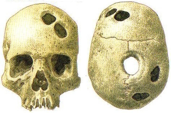 <p>practice in which holes were drilled into the skull in an attempt to release evil spirits</p>