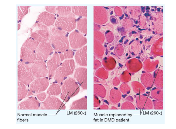<p><span>a progressive and severe muscle-wasting disease primarily affecting boys, caused by a lack of the protein dystrophin</span></p>