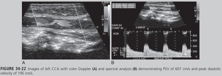 <p>A 67-year-old man developed acute blindness in the left eye while at work. When he arrived at the hospital, he claimed to have got ten lost in the elevator. Staff noticed he appeared uncoordinated and confused and had trouble expressing himself. A carotid sono gram demonstrated the finding in Figure 34-22 (see Color Plate 53) in the left CCA. The left vertebral artery was found to be occluded. After 3 days, the patient’s symptoms completely resolved. What do these findings suggest?</p>