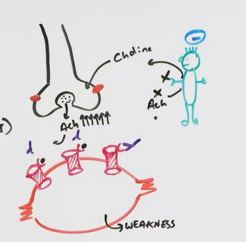 <p>Autoimmune disease, autoantibodies attack nicotinic receptors and block nicotinic binding sites</p><p>Causes weakness</p><p>Tx = meds that inhibit AChE (ACh build-up to kick out blockers)</p>