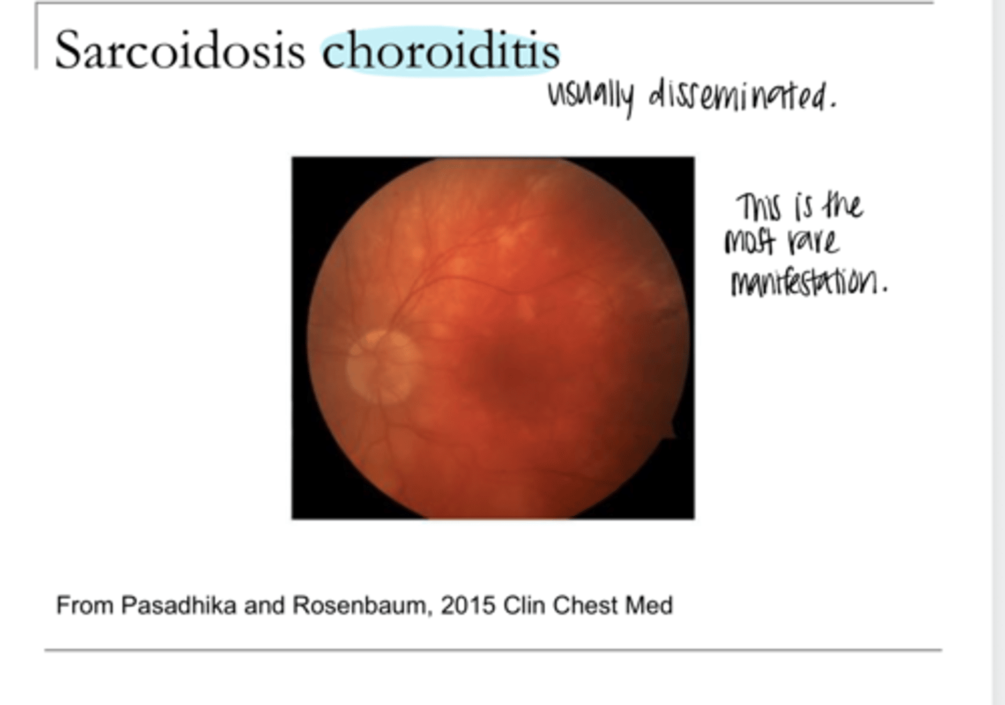 <p>Sarcoidosis Choroiditis (Pic)</p>