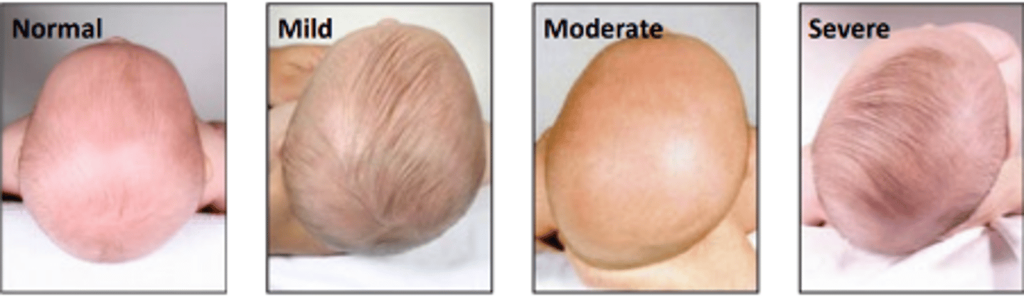 <p>premature unilateral fusion of all cranial sutures on a single side of the head resulting in a flattening of one side of the skull producing a rhomboid shape.</p>