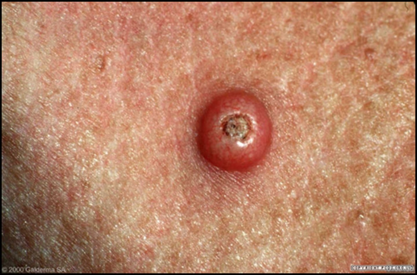 <p>-<strong>rapidly growing, well-differentiated neoplasm of squamous epithelium</strong></p><p><span style="color: red;"><strong>-considered by many to be a low-grade SCC</strong></span></p><p>-appear and grow rapidly over a few weeks and spontaneously involute and resolve within 6 months, leaving an atrophic scar</p><p>-immune system is thought to play a role in the spontaneous regression of these</p>