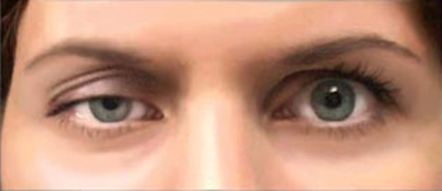 <p>Drooping of the eyelid; occurs with cranial nerve damage or systemic neuromuscular weakness</p>