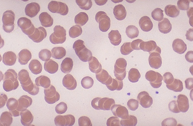 <p>what disease/condition is associated with excessive rouleaux?</p>