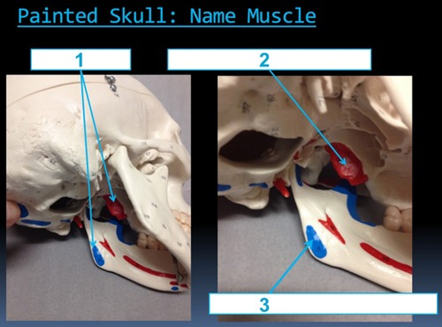 <p>#18 insertion</p>