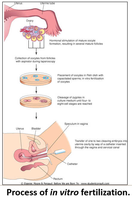 <ol><li><p class=""><strong>Hormonal stimulation</strong> triggers ovulation to capture multiple <strong>oocytes</strong>.</p></li><li><p class=""><strong>Fertilization</strong> and early <strong>cleavages</strong> occur in a <strong>petri dish</strong>. A <strong>single blastomere</strong> may be removed for <strong>genetic testing</strong>.</p></li><li><p class="">The embryo is <strong>placed into the uterus</strong> at the <strong>4–8 cell stage</strong>, and <strong>two embryos</strong> are often used to increase the <strong>chances of implantation</strong>.</p></li></ol><p></p>