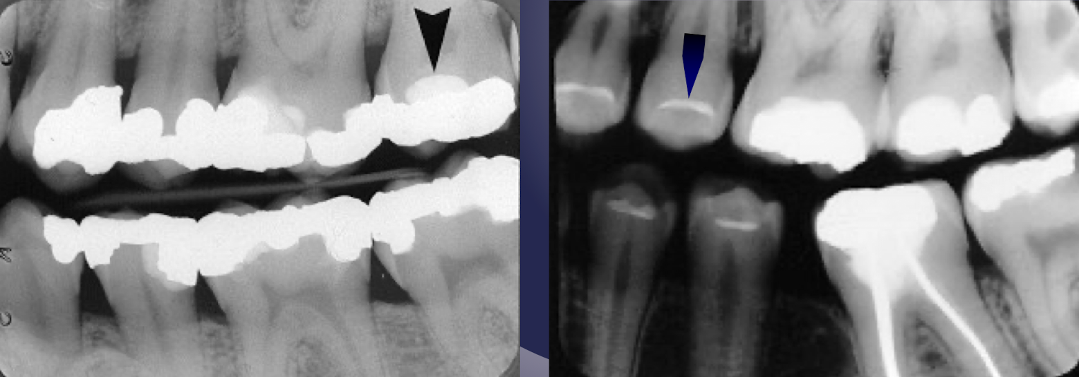 <p>which restorative material?</p>
