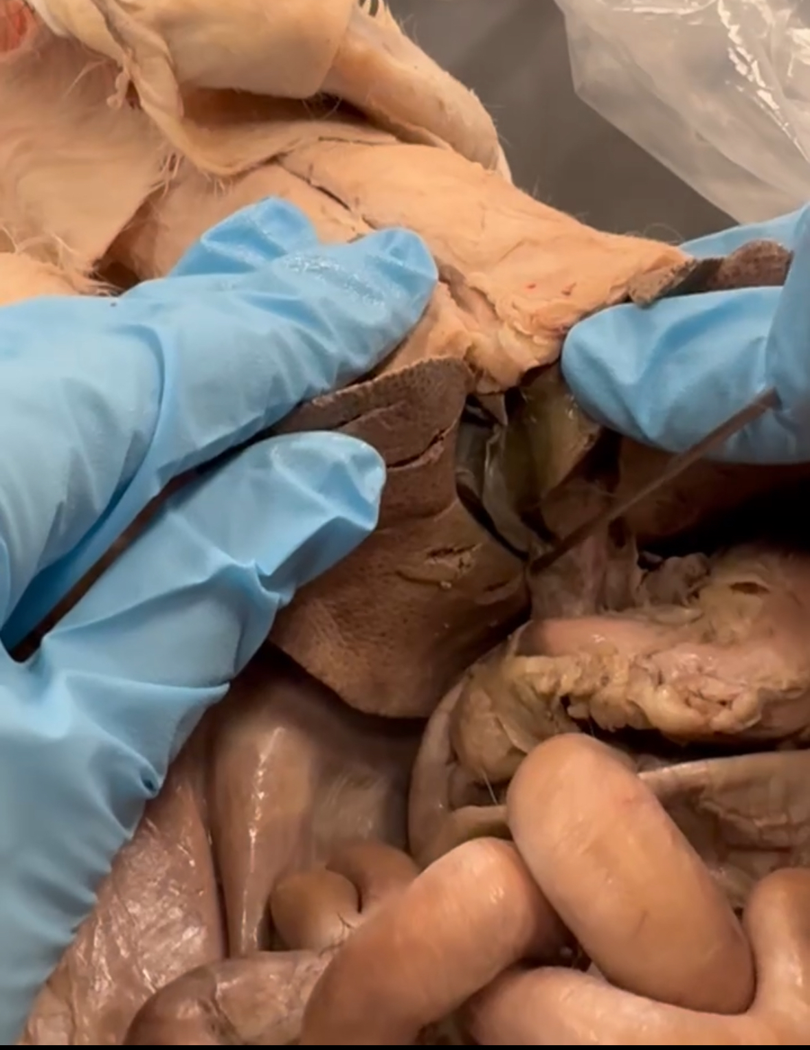 <p>connects from gallbladder to duodenum</p>