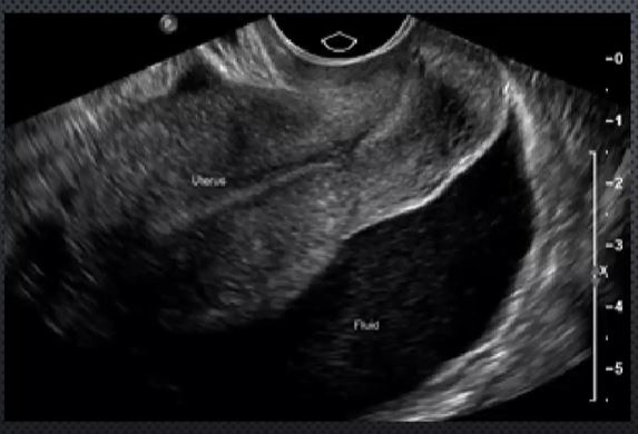 <p>Positive HCG, but there’s fluid + adnexal mass = </p>