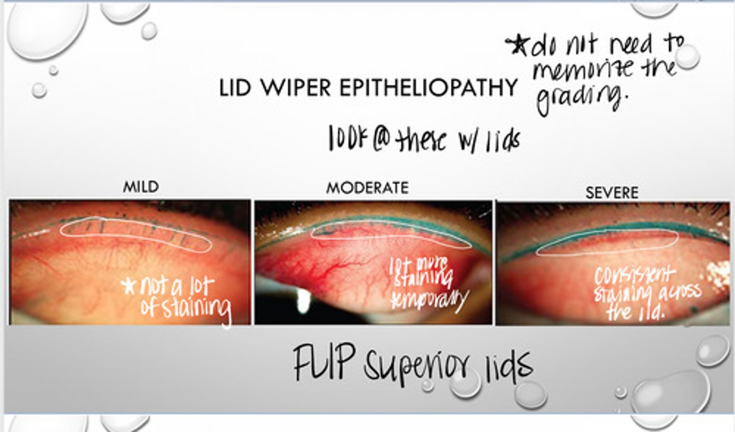<p>Grading Lid Wiper Epitheliopathy</p><p>0 = ? </p><p>2.25-3?</p>