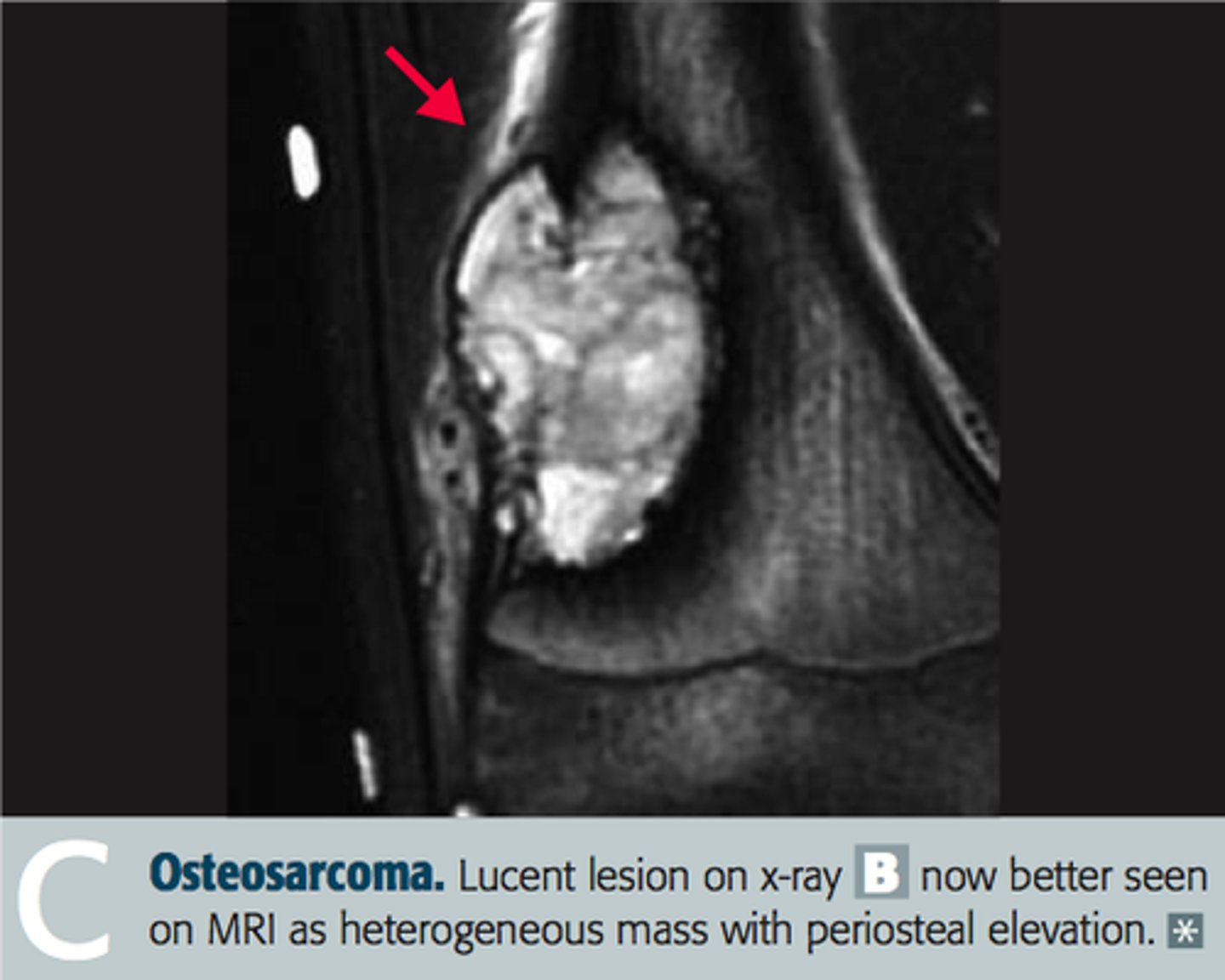 <p>tumor type: malignant bone tumor (primary)</p><p>epidemiology/location:</p><p>- 2nd most common primary malignant bone tumor (after multiple myeloma)</p><p>- bimodal distribution: 10-20 yo, > 65</p><p>- location --> metaphysis of long bone often around knee</p><p>predisposing factors:</p><p>- paget disease of bone</p><p>- bone infarcts</p><p>- radiation</p><p>- familial retinoblastoma</p><p>- li-fraumeni syndrome (germiline p53 mutation)</p><p>characteristics:</p><p>- Codman triangle (from elevation of periosteum) or sunburst pattern on x-ray</p><p>- aggressive, treat with surgical en bloc resection (with limb salvage) and chemotherapy</p>