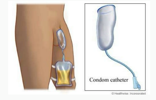<p><strong>Condom Catheter</strong></p><p>-A ______ similar to a condom fits around the penis, and a tube takes the urine into a bag</p><p>-It can ____ or leak</p><p>-Doesn’t ___________ the bladder, not an option if patient is in ___</p>