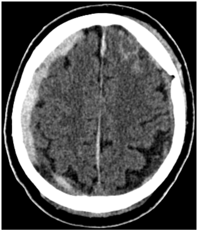 <p>What can be seen in this CT image?</p>