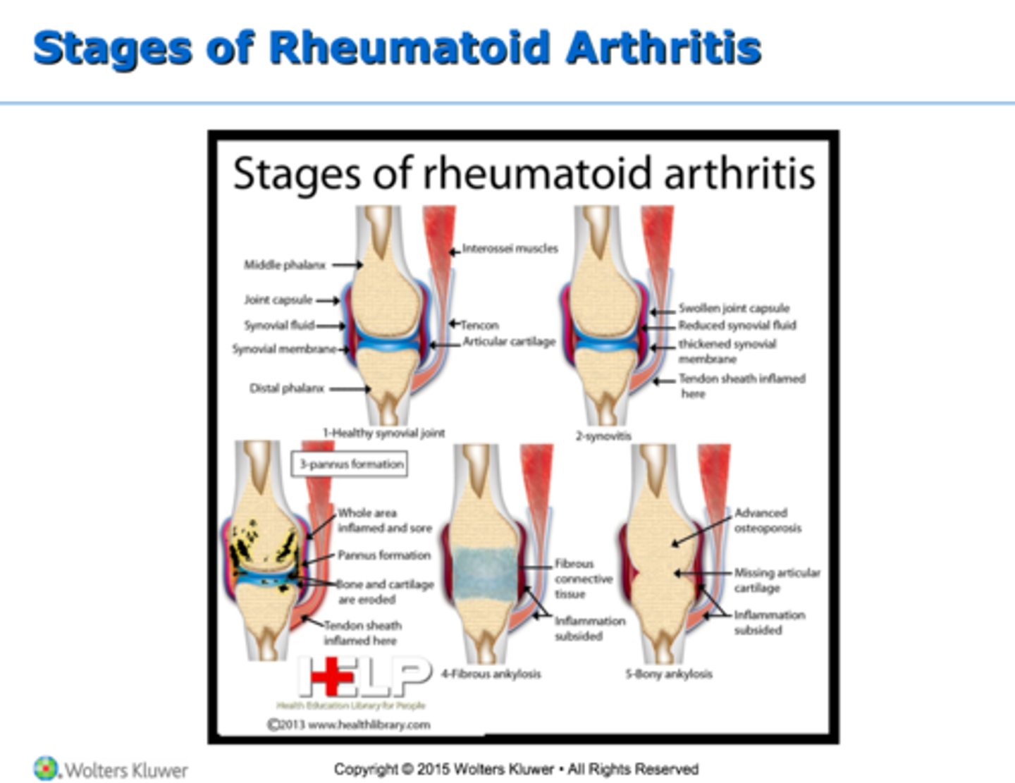 <p>1) acute (flares up)</p><p>2) subacute</p><p>3) chronic active,</p><p>4) chronic inactive.</p>