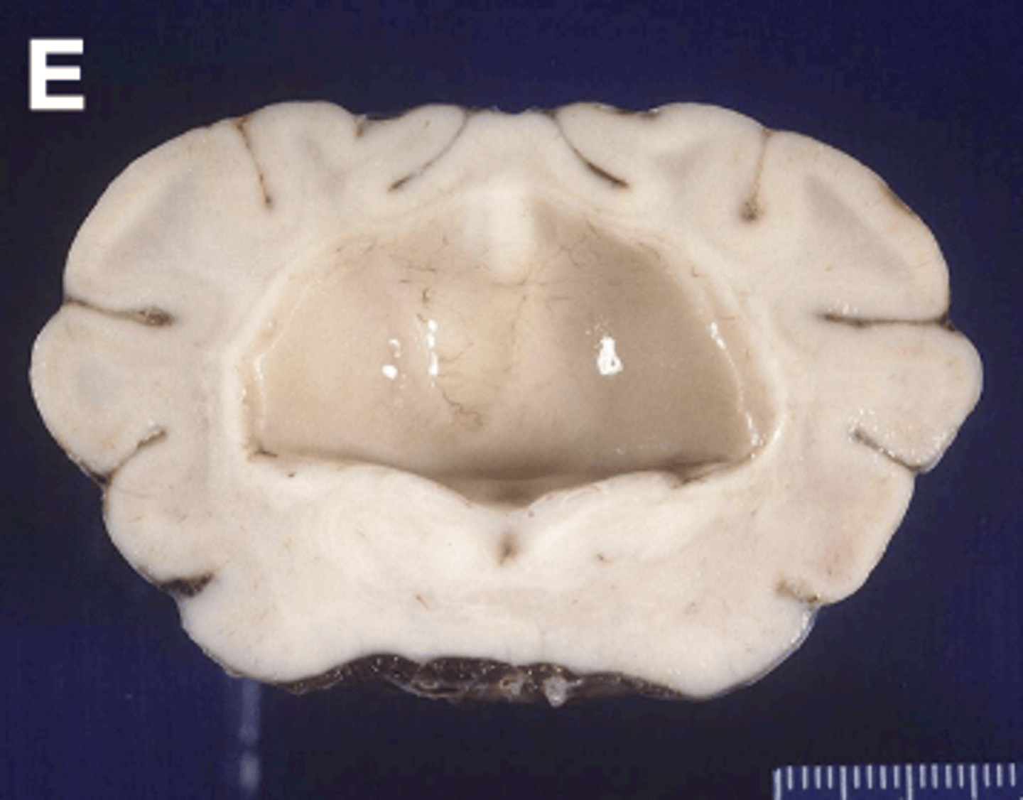 <p>- "whole prosencephalon" - fusion of the two hemispheres of the prosencephalon into one structure. Also associated with cyclopia.</p>