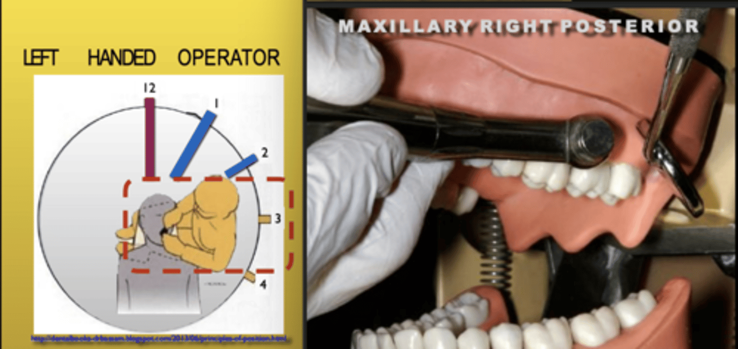 <p>Zone: 3</p><p>Vision: Direct</p><p>Patient's Head: Left</p><p>Fulcrum: Max anteriors (I)</p>