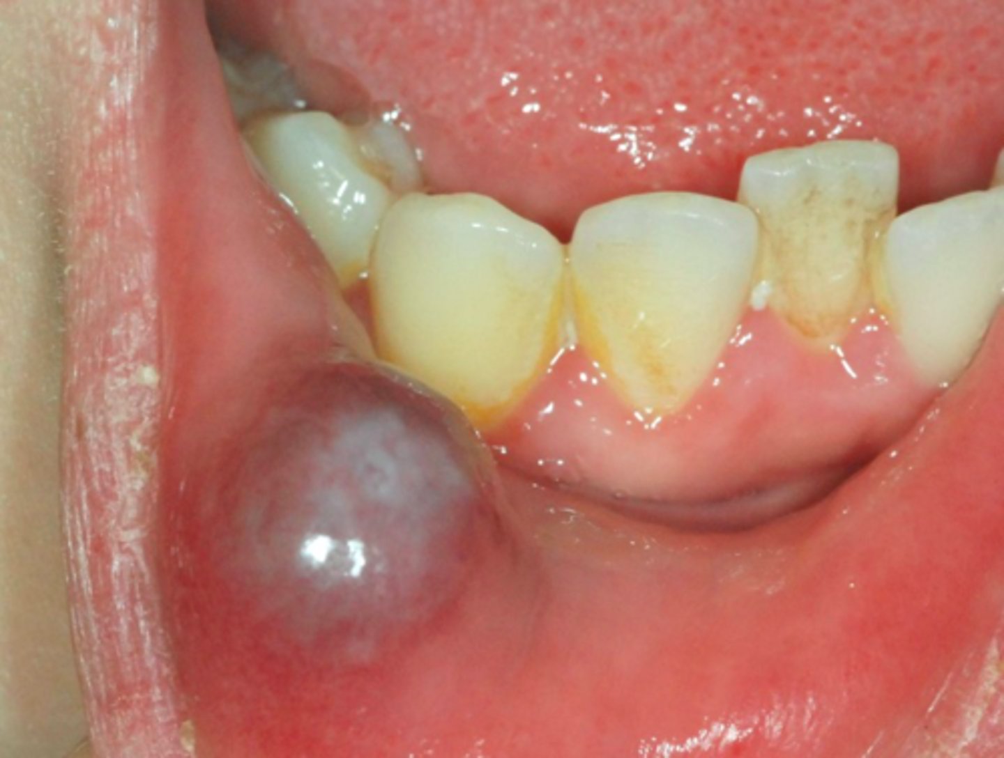 <p>Patient presents with a dome-shaped fluctuant vesicle that looks <strong>bluish</strong> in color on the lower lip. Patient admits to biting lip sometimes. Patient also said that "sometimes the <strong>bump gets big and then shrinks again</strong>"</p>