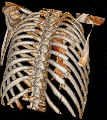<p>most common cause of rib fractures</p><ul><li><p>direct pressure on ribs = break</p></li></ul>