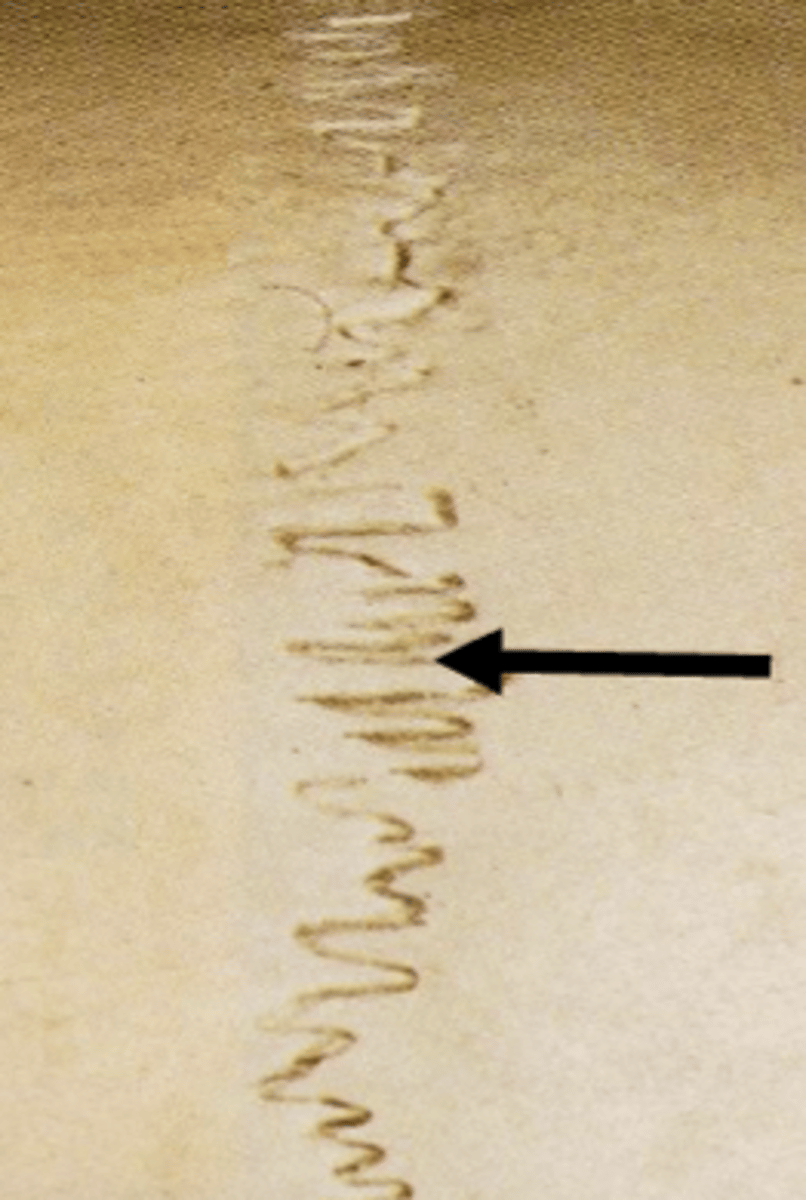 <p>sagittal suture</p>