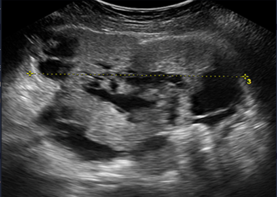 <p>Ovarian cancer can present as either a ____, ____, or  _____ mass</p>