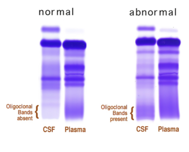 <ul><li><p>oligoclonal bands</p></li><li><p>prescsnec of myelin basic protein</p></li><li><p>calculation of IgG index: ratio high</p></li></ul><p></p>