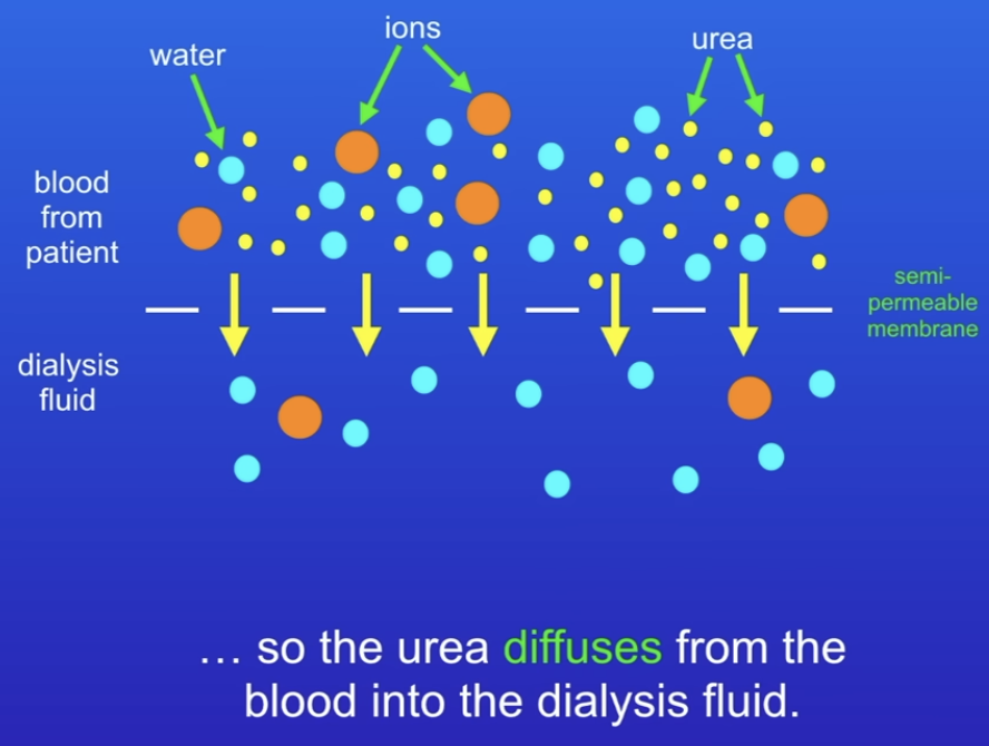 <ul><li><p>Kidney failure means blood contains too much urea, ions and water</p></li><li><p>Kidney dialysis: patients blood passes over a semi-permeable membrane which allows smaller molecules through</p></li><li><p>Dialysis fluid on other side of membrane - controls normal concentration of water and ions but no urea</p></li><li><p>Steep concentration gradient lets smaller molecules pass through.</p></li></ul><p></p>