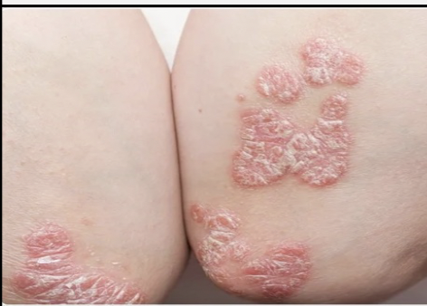 <p>Autoimmune disorder in which too many abnormal epidermal cells are produced; produces itch, silvery scales, and plaques.</p>