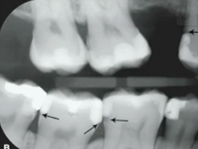 <p>what are these lesions</p>