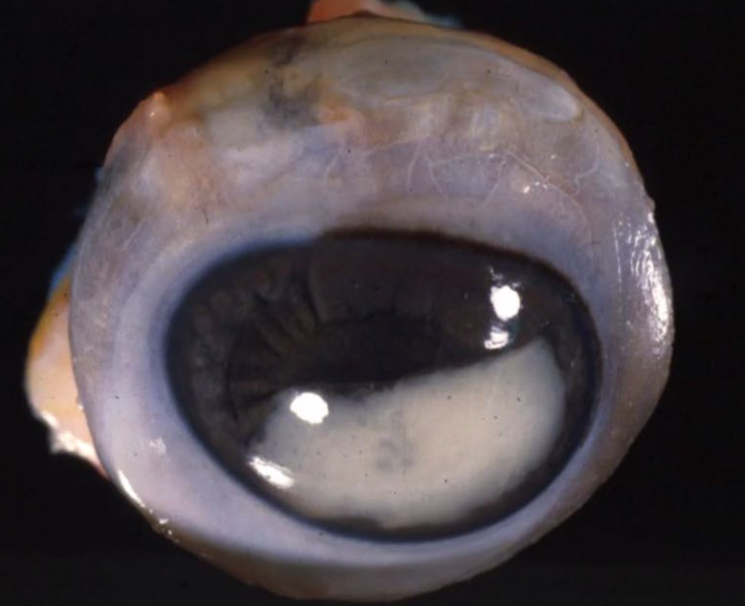 <p>What is the dagnosis?</p><p>A-Hypopyon</p><p>B-Hyphema</p><p>C-Corneal edema</p><p>D-1 ris prolapse</p>
