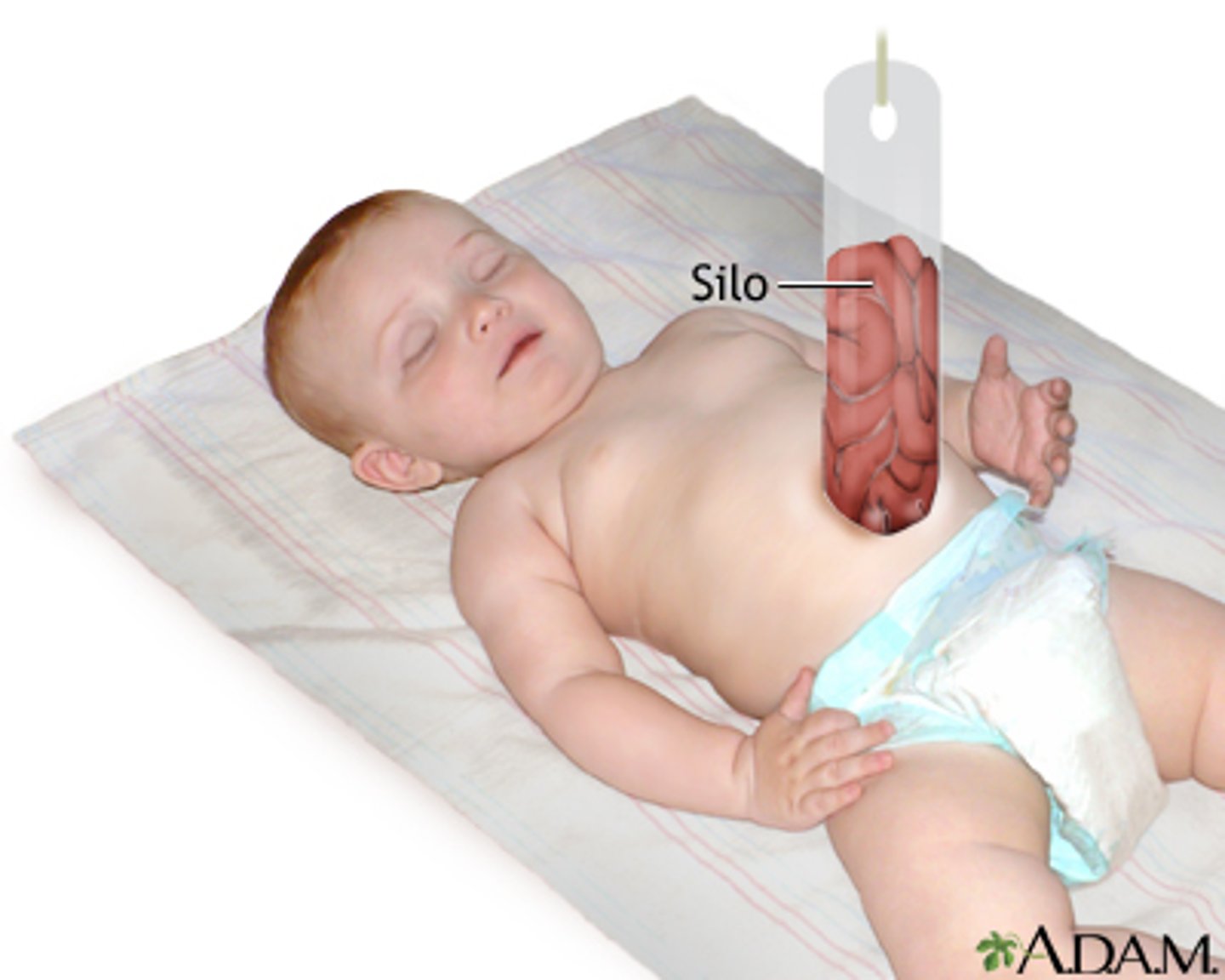 <p>suspended which allows gravity to push contents into peritoneal cavity gradually</p><p>- staple lines across the top portion of the bag can speed up this process</p>