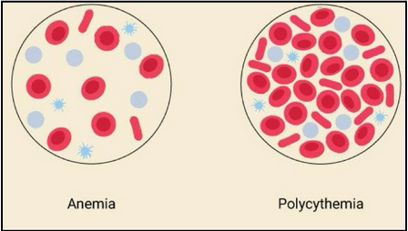 <ul><li><p><span style="background-color: transparent;">Anemia: reduced capacity to carry oxygen</span></p><ul><li><p><span style="background-color: transparent;">Not always due to reduced number of RBCs</span></p></li><li><p><span style="background-color: transparent;">Can be caused by iron deficiency (cannot bind oxygen to heme), pernicious (B12 deficiency) or hemorrhagic</span></p></li></ul></li><li><p><span style="background-color: transparent;">Polycythemia: too many circulating RBCs</span></p><ul><li><p><span style="background-color: transparent;">Too viscous and can lead to blood clots and eventually strokes</span></p></li></ul></li></ul><p></p>