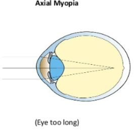 <p>eye is too long even if the cornea and lens bend light normally the retina is further back so image focuses in front of it&nbsp;</p>