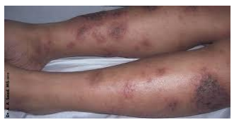 <p>what type of eczema is this?</p>