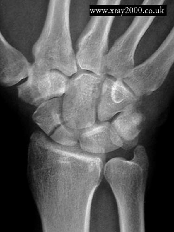 <p>most common fracture of carpals, often difficult to see on initial plain films; can lead to avascular necrosis of scaphoid/navicular bone</p>