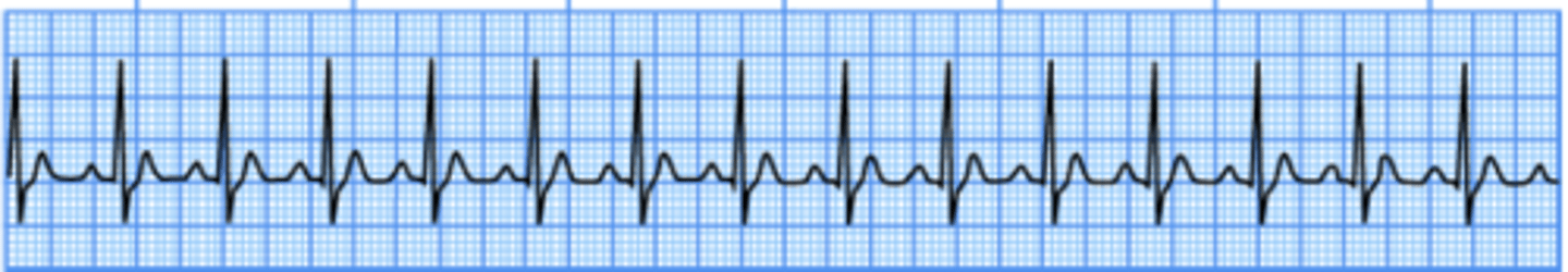 <p>Identify the following cardiac rhythm:<br>A. Normal sinus rhythm<br>B. Atrial fibrillation<br>C. Sinus tachycardia<br>D. Ventricular tachycardia</p>
