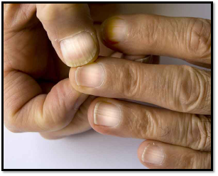 <p>aging, underlying disease-1/2 moon</p>