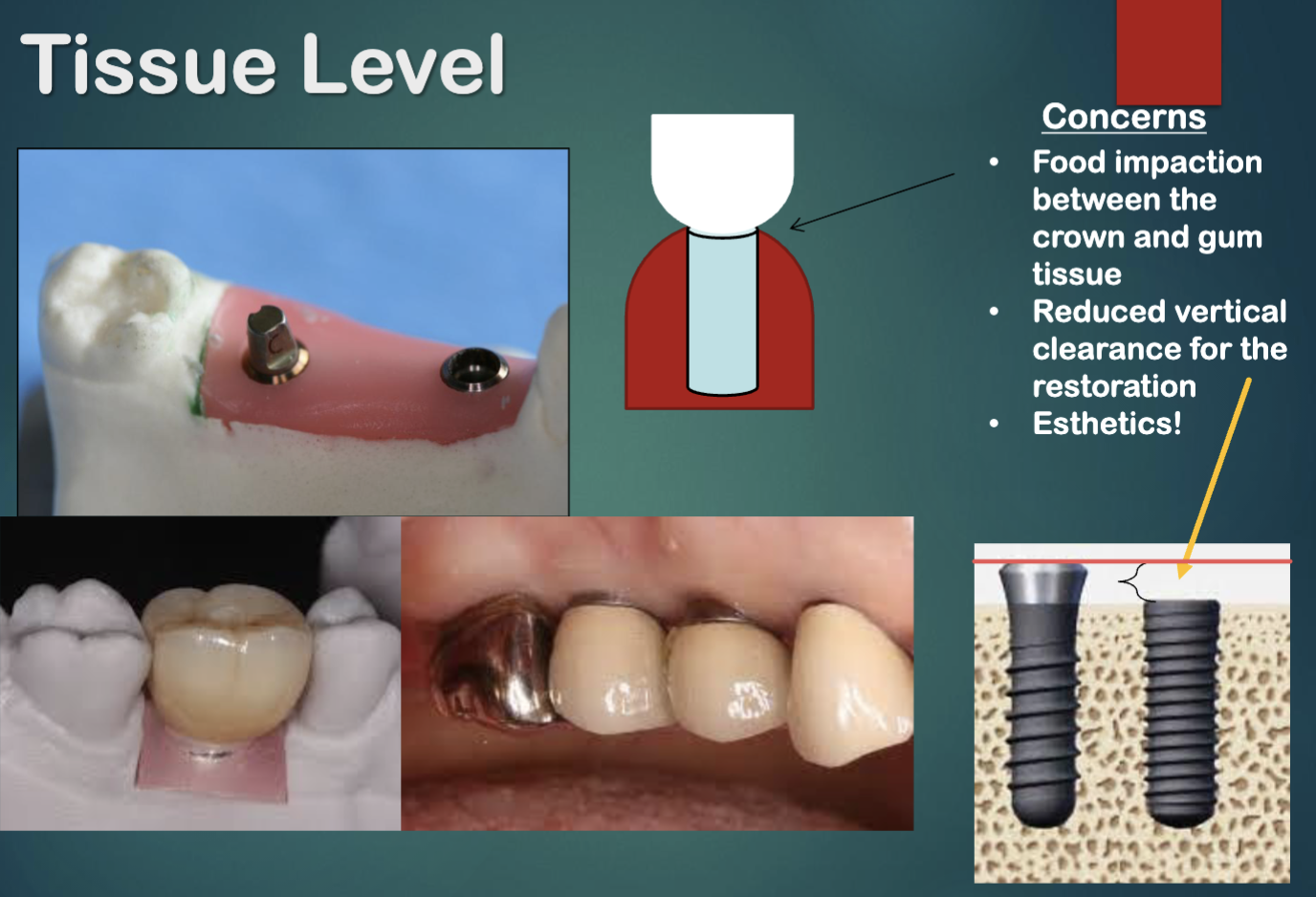 <ul><li><p>food impaction between crown and gum tissue </p></li><li><p>reduced vertical clearance for the restoration </p></li><li><p>esthetics </p></li></ul><p></p>