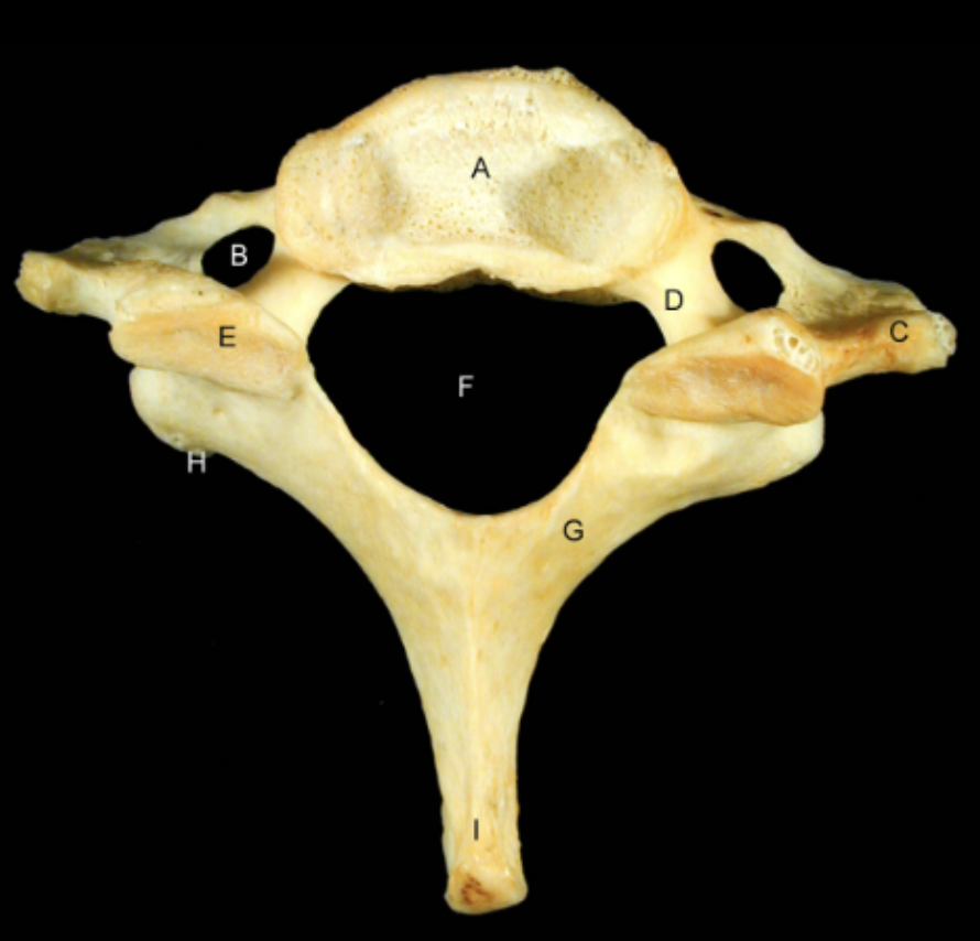 <p>Identify the Structures of the Cervical Vertebrae - C6 Superior View</p>