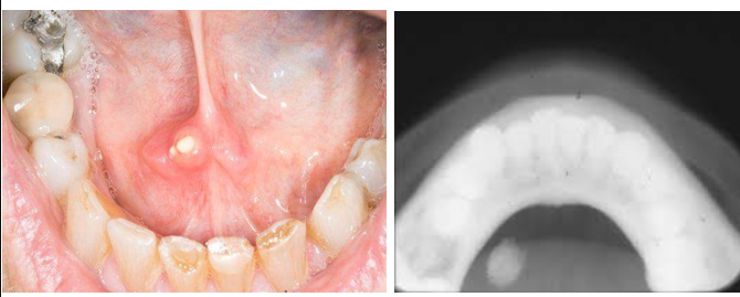 <p>What is a sialolith? What is a ranula? </p>