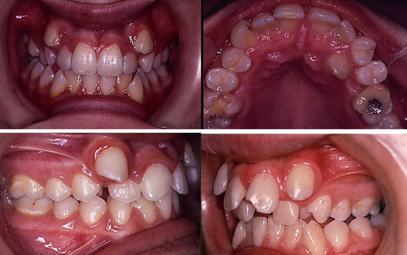 <p>Expressed as either overlap or protrusion</p><p>Teeth may not all erupt causing retention or ectopic tooth position</p>