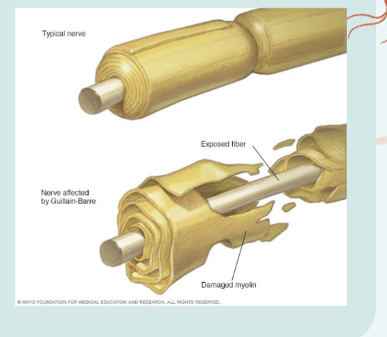 <p>Guillain- Barre Syndrome </p>