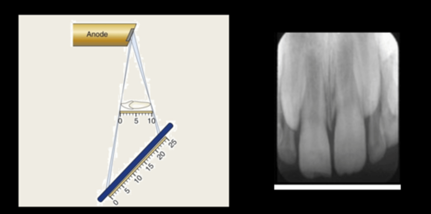 <p>underangulation</p>
