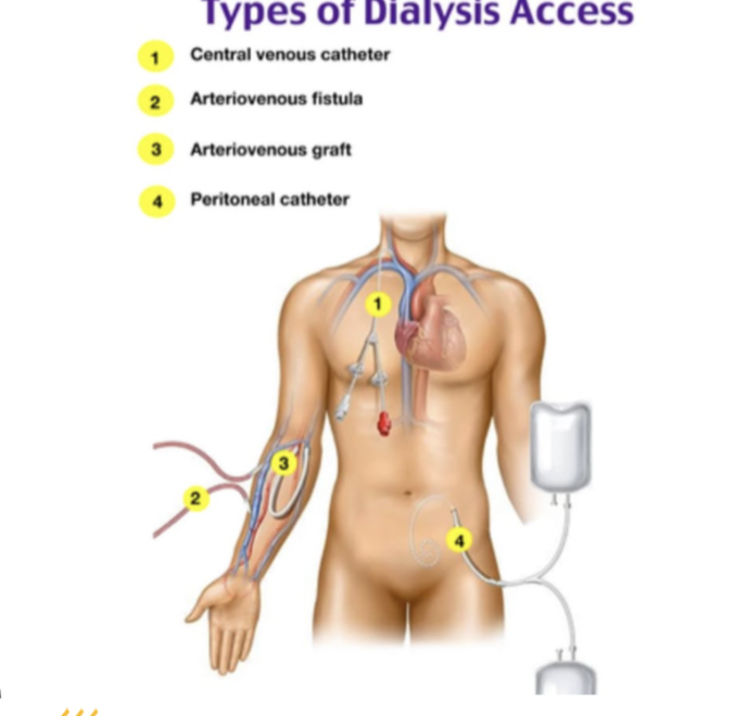 <p>What are the indications for vein mapping in a patient preparing for dialysis access?</p>