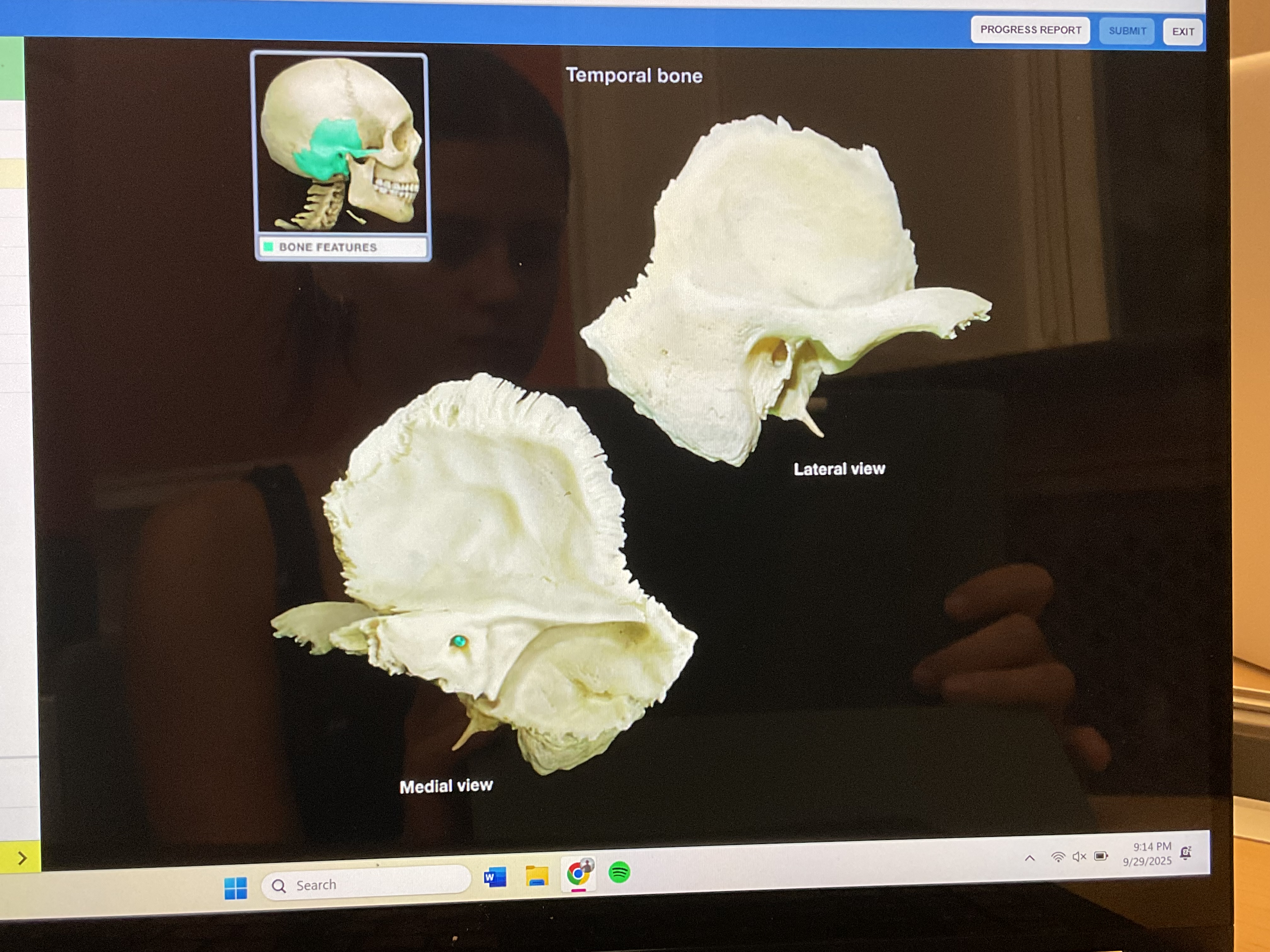 <p>Internal acoustic meatus </p>