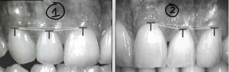 <p>1- gingival margin of lateral incisors should be more coronal than that of central and canines</p><p>2- lateral incisors gingival margin apical </p>